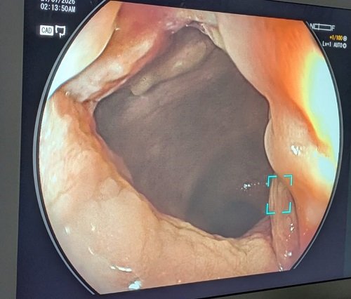 Colonoscopy