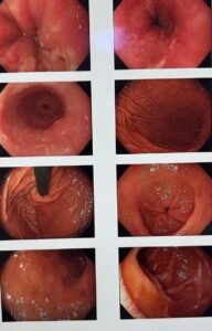 Gi endoscopy