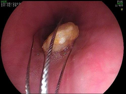 Endoscopic foreign body removal