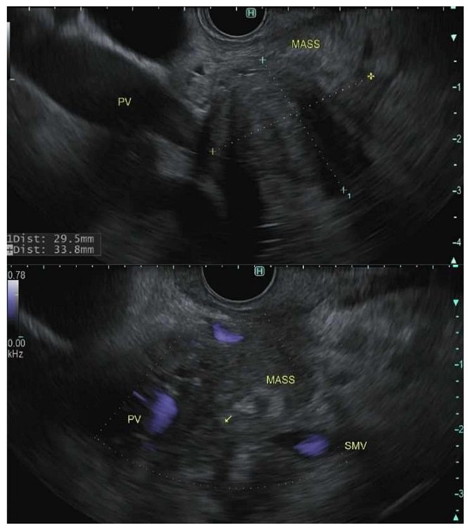 Endoscopic ultrasonography