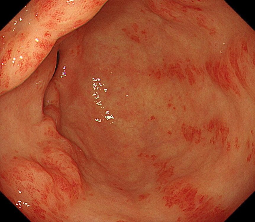 Stomach Disease