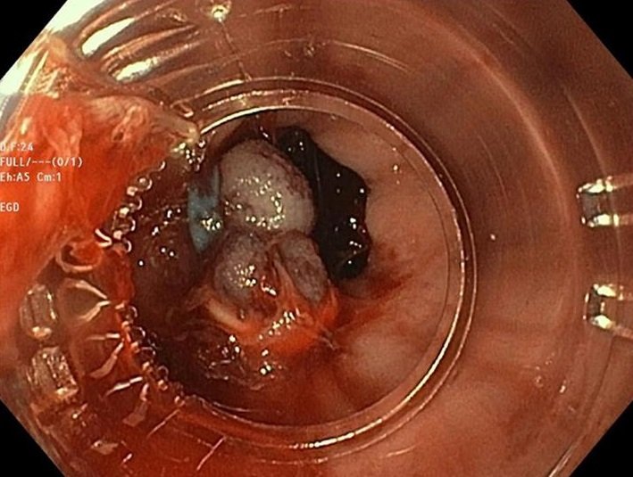 Variceal Banding