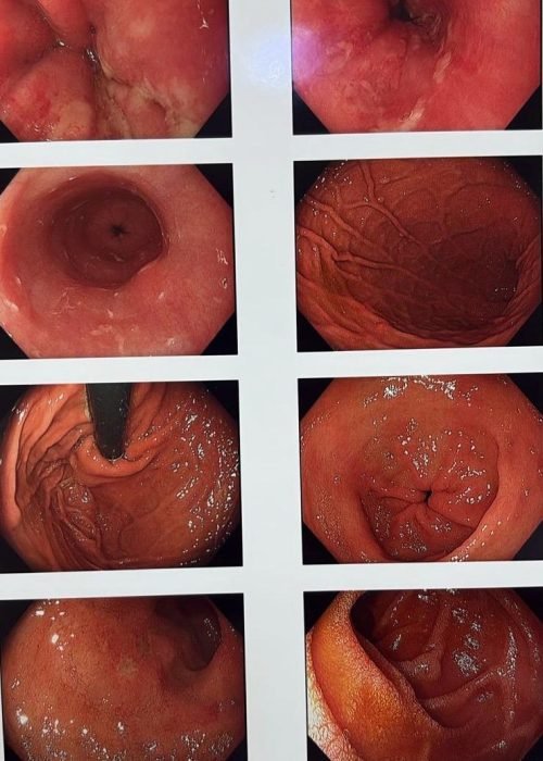 Gi endoscopy